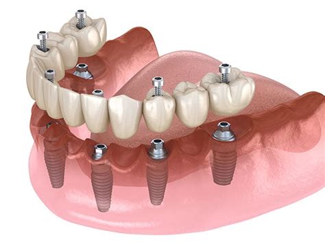 All-on-6, Implant Services - Elite Dental Lab