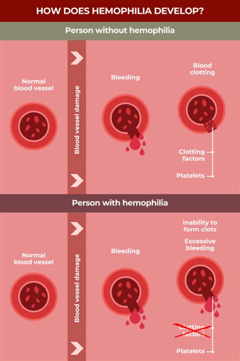 What is hemophilia? | Hemophilia News Today