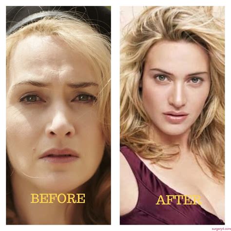Kate Winslet Before And After Plastic Surgery 30 Cele - vrogue.co