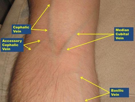 Phlebotomy Technique: Approach Considerations, Phlebotomy, Complications | Nurse, Phlebotomy ...