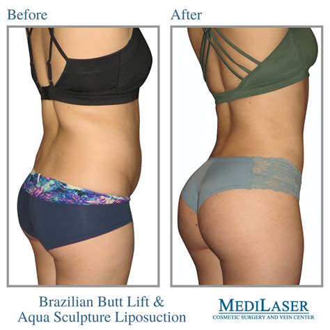 Brazilian Butt Lift Before and After - Medilaser Surgery and Vein Center