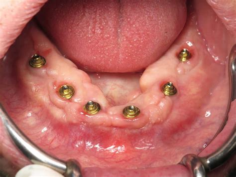 What are Multi-unit Abutments?