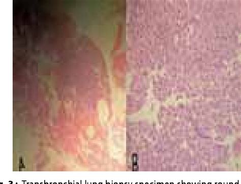 Figure 3 from Squamous cell lung cancer producing bilateral air bronchograms on CT scan thorax ...