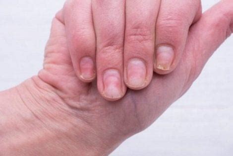 Comment éviter les ongles incarnés en les coupant correctement - Améliore ta Santé