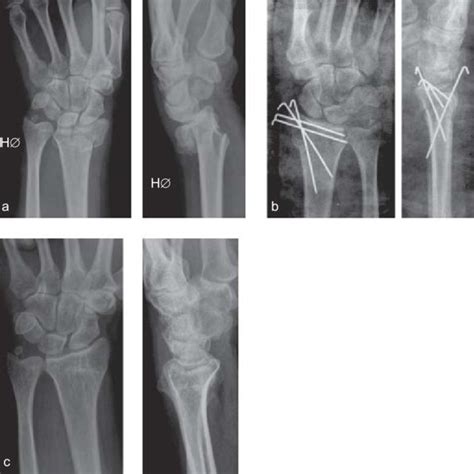 (PDF) Percutaneous pinning of fractures of the distal radius