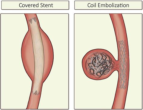 Coronary Artery Aneurysms, Arteriovenous Malformations, and Spontaneous Dissections—A Review of ...