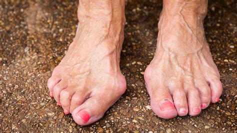 Hallux valgus: causes, prevention, treatment | gesund.bund.de