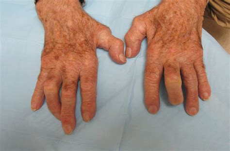 Osteoarthritis Nodules On Finger Joints