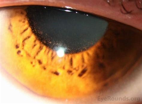 File:EyeRounds Case 338, Fig1-slit-lamp-intraepithelial-refractile-microcysts-OD-LRG.jpg - NC ...