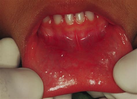 Mucocele Floor Of Mouth