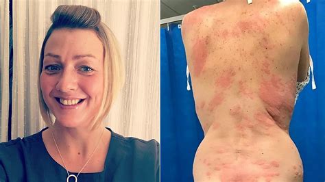 Woman claims allergic reaction to vape caused painful rash, required hospital visit | Fox News