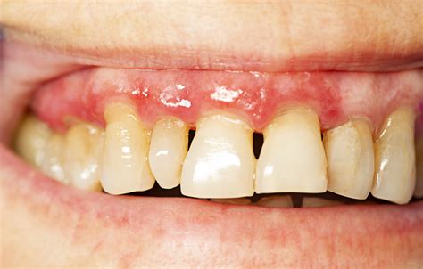 Gum Disease Beverly Hills, CA - Dental Group Of Beverly HIlls