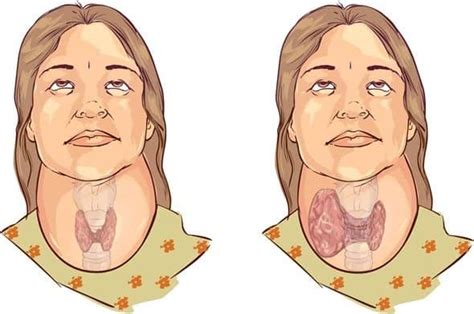 Goitre Classification & Pathology - New