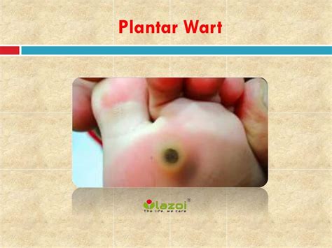 PPT - Plantar Wart: Causes, Symptoms, Daignosis, Prevention and Treatment PowerPoint ...