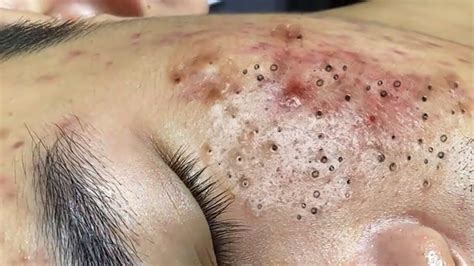 Relaxing Make your Acne Treatment Sac Dep Spa #1011 | Blackheads & Pimple Removal - YouTube