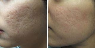 Microdermabrasion for Acne Scars | Dr Chen Tai Ho