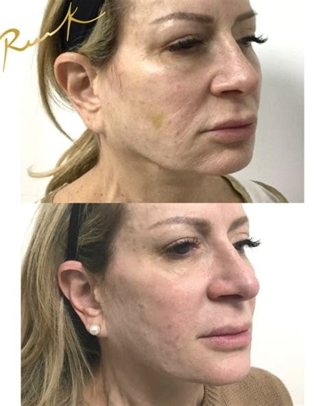 Stem Cell Facelift — Russak+ Aesthetic Center