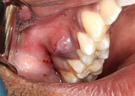 Abscess After Wisdom Tooth Removal - Picasso Dental Clinic Vietnam