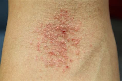 Eczema Skin Causes Symptoms Types Diagnosis Treatments Tips | My XXX Hot Girl