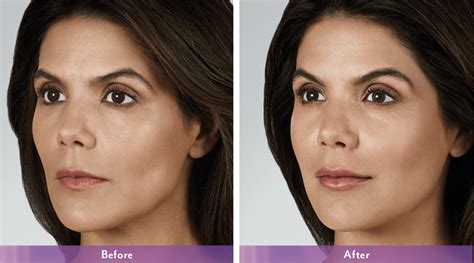 Juvederm | Cheek Fillers | Juvederm Toronto - Skin Vitality Medical