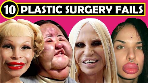 TOP 10 BOTCHED PLASTIC SURGERY FAILS - ( Plastic Surgery Before and After | FACE ) - Clínica de ...