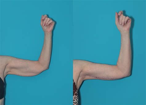 Arm Lift Before and After Pictures Case 324 | West Des Moines & Ames, IA | Koch & Carlisle ...
