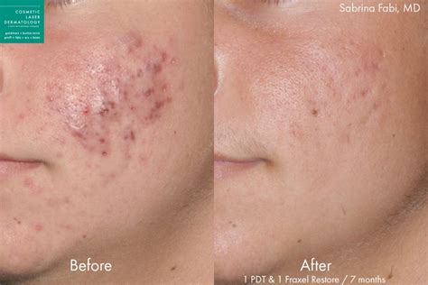 Photodynamic Therapy Acne Treatment | San Diego, CA | CLDerm