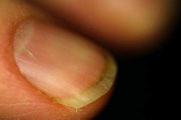 Quick Tips: 5 Ways to Treat Cracked Nails | HowStuffWorks