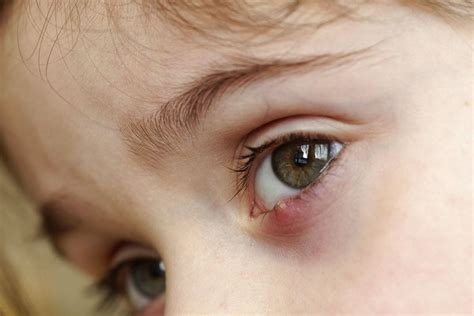 Eye Stye (Sty): What Is it? Causes & Treatment | MyVision.org
