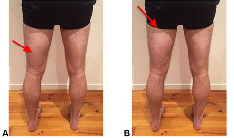 Hamstring Injury - Causes, Symptoms, Recovery Time & Treatment