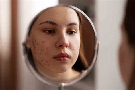 Postpartum Acne Causes And Symptoms - Klarity Health Library