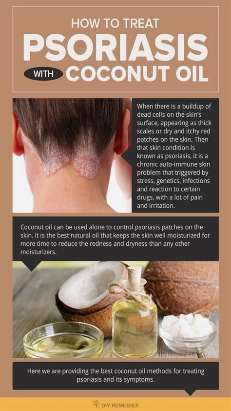 Psoriasis Diet - How to Treat Psoriasis with Coconut Oil - #DIY #Natural Home Remedies. Here are ...