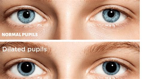 What Causes Dilated Pupils and How to Treat Them?