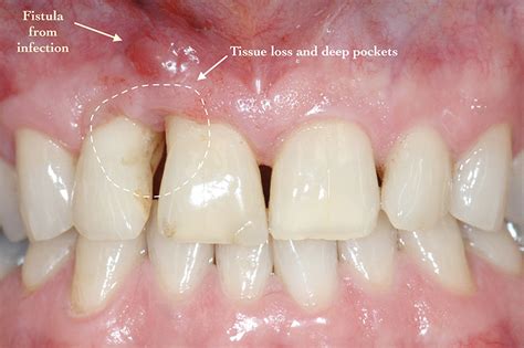 Alveolar Bone Loss