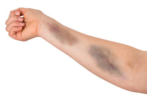 Bruised Arm Stock Photos, Pictures & Royalty-Free Images - iStock