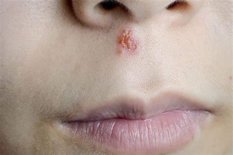 How to Know if You Have Herpes on Lips - Galindo Begaings