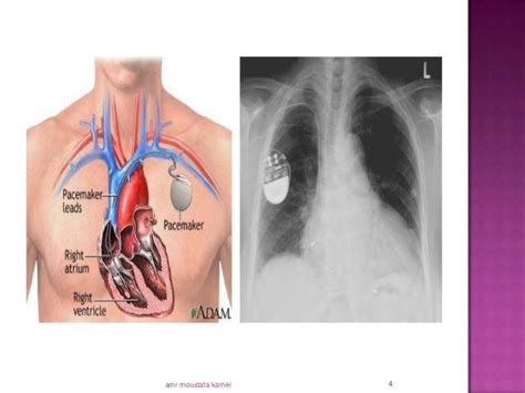 Anethesia and cardiac implantable electronic devices
