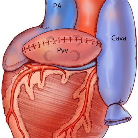 Perfusion of Blood Through the Heterotopic Cardiac Graft: The graft is... | Download Scientific ...