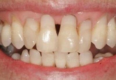 gingival veneer cost