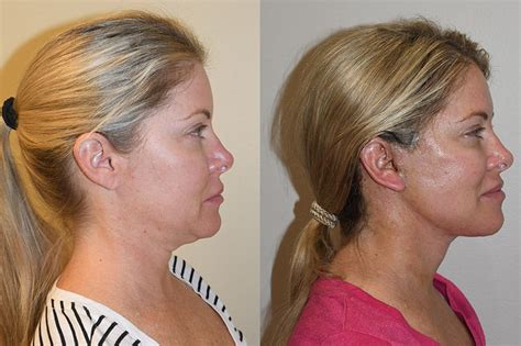 Facelift Recovery Guide - Abstra Kraft