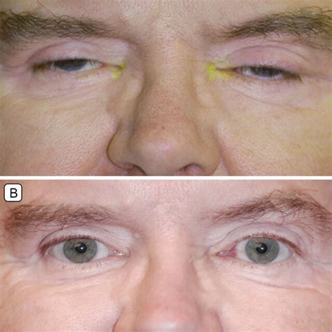 Demonstration of improvement of blepharospasm after protractor ...