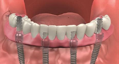 What are full mouth dental implants and what do they cost? - TeethXpress (2023)