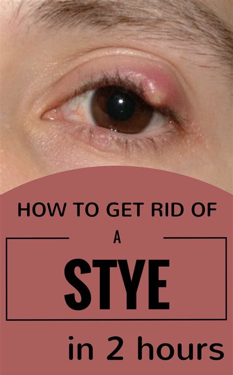 stye removal surgery near me - mertonroegner-99