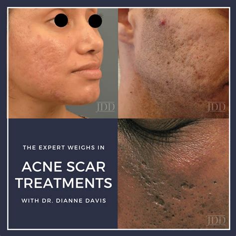 Acne Scar Treatments: The Expert Weighs In - Next Steps in Dermatology