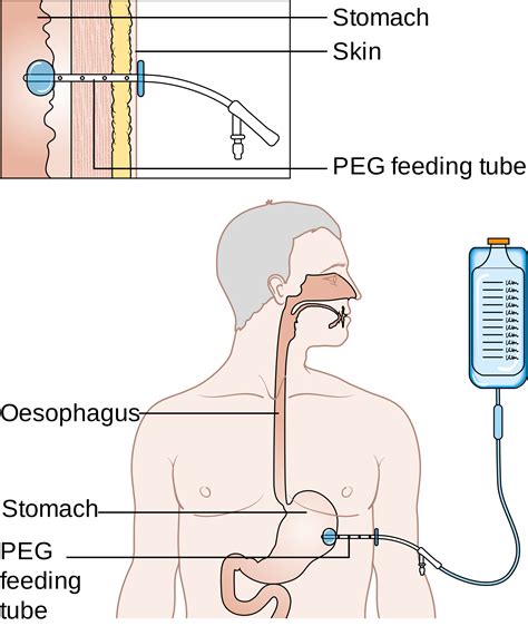 peg tube - Google Search | Peg tube, Peg, Feeding tube