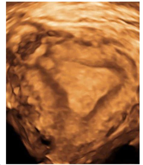 US image of interstitial pregnancy | Download Scientific Diagram