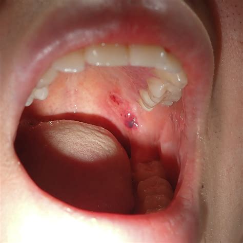 Causes Of Blood Blisters In Mouth