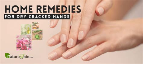 8 Home Remedies for Dry Cracked Hands - Natural Treatments [that Work]