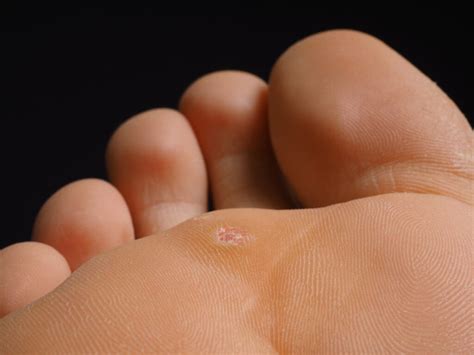 Plantar wart removal guide | Family Foot & Ankle Centers