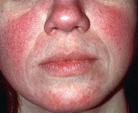 Rosacea: Diagnosis and Management of a Complex and Significant Disorder | Consultant360